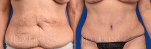 Patient 1 Before and After Abdominoplasty Front View