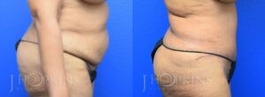 Patient 1 Before and After Tummy Tuck Right Side View