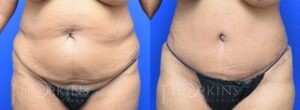 Patient 1 Before and After Tummy Tuck Front View