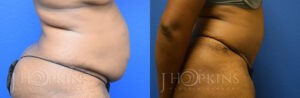 Patient 3 Before and After Tummy Tuck Right Side View