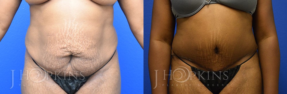 Patient 3 Before and After Tummy Tuck Front View