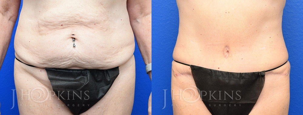 Tummy Tuck Before and After Photos - Patient 7A